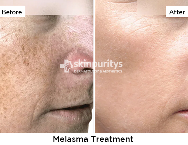 Melasma results